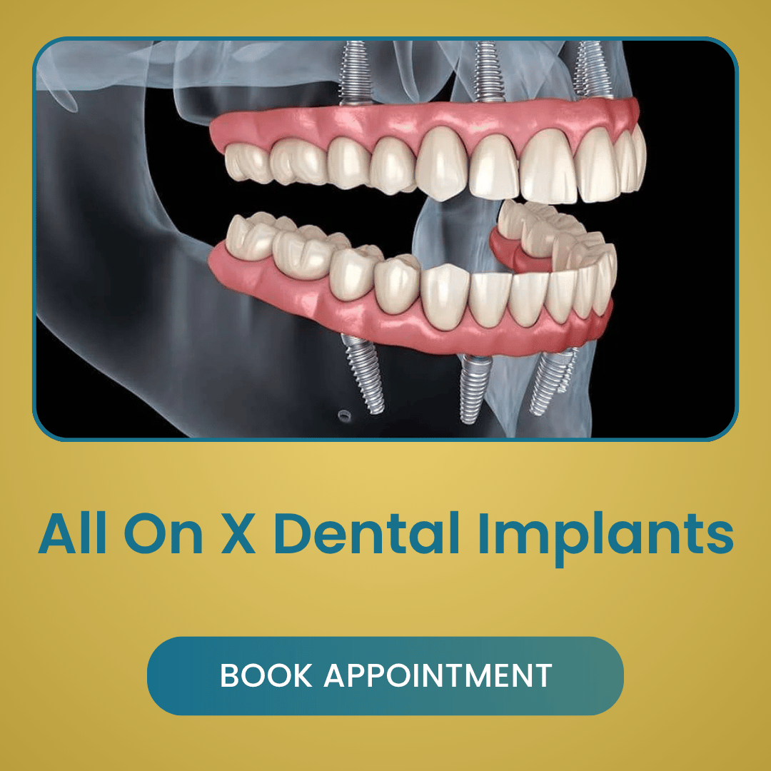 All On X Dental Implants