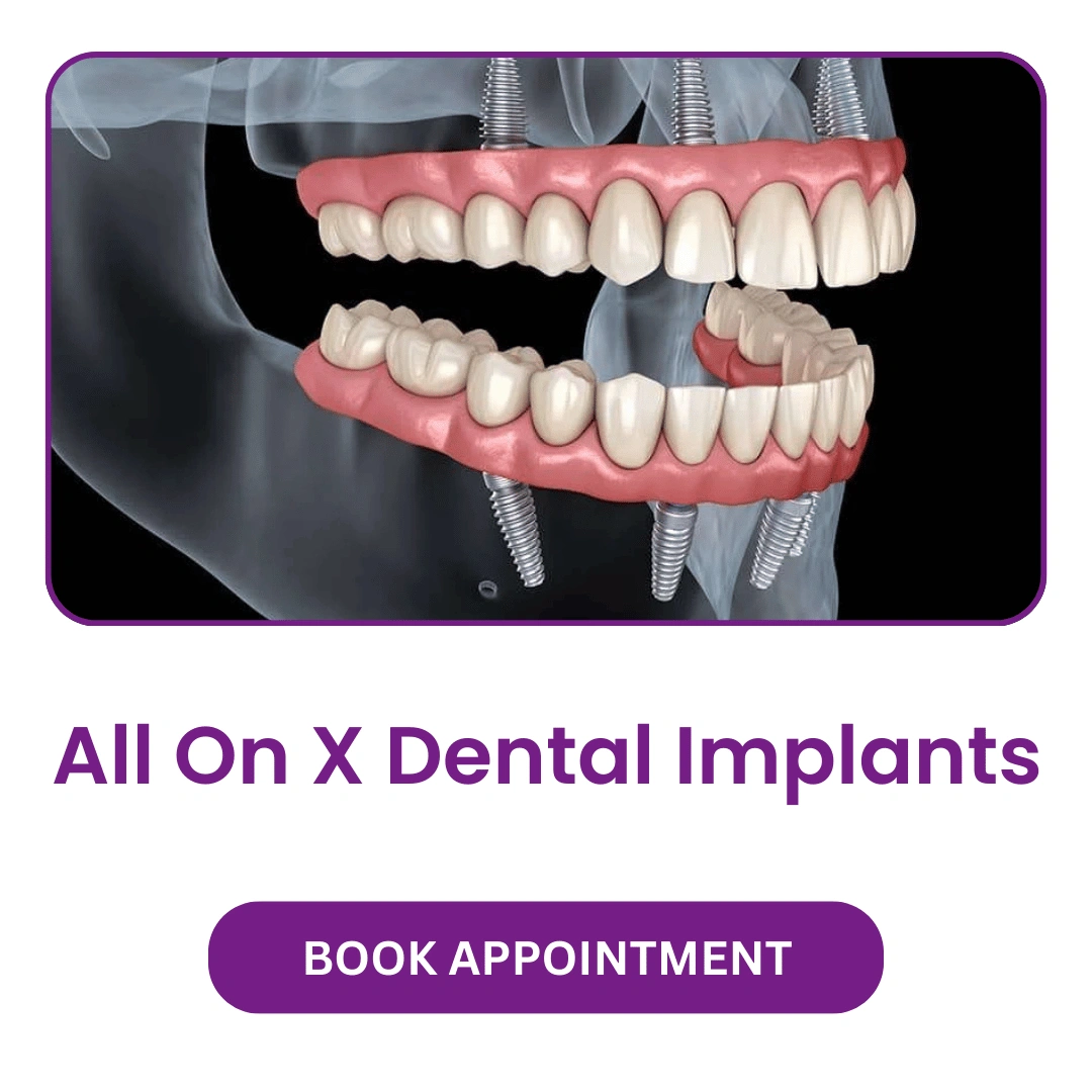 All-On-X-Dental-Implants.webp