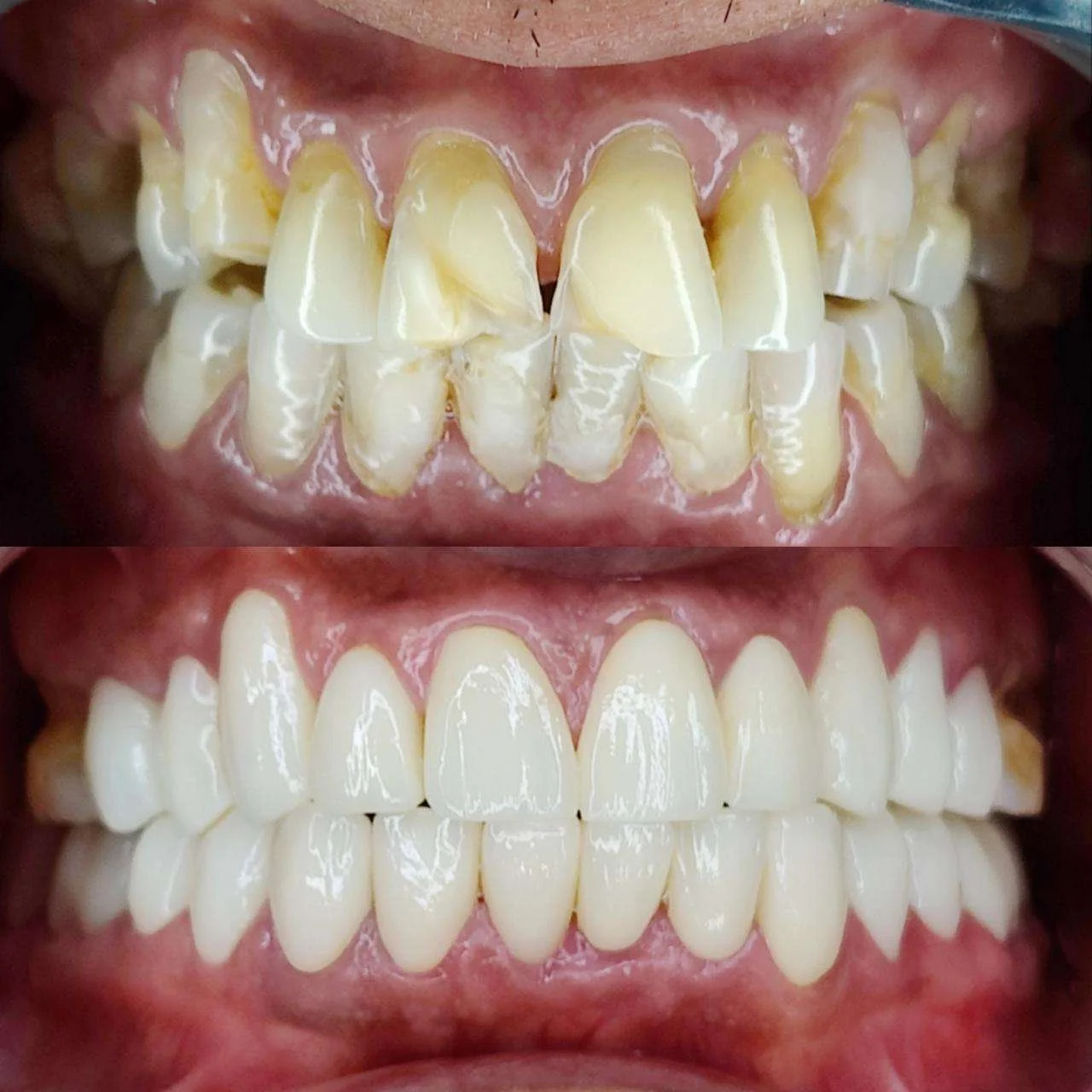 Before-After.webp