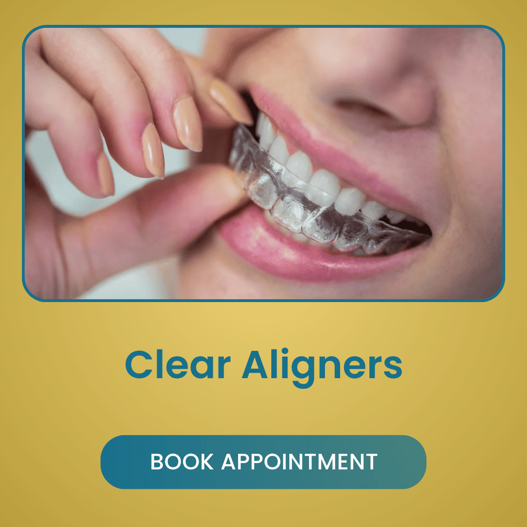 Clear Aligners