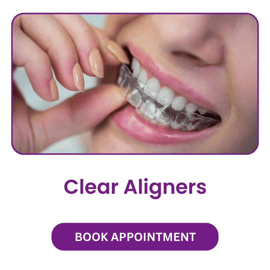Clear-Aligners.webp