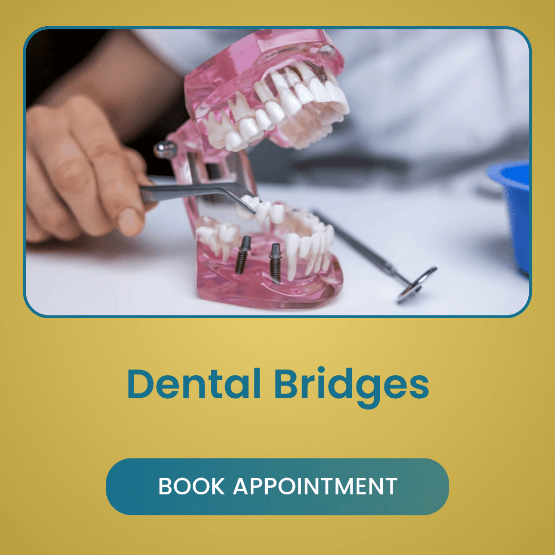 Dental Bridges