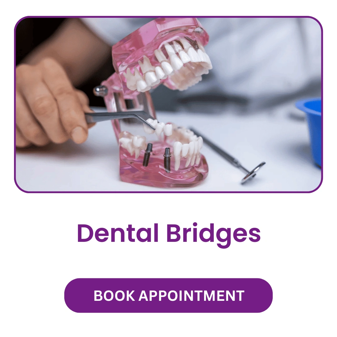 Dental-Bridges.webp