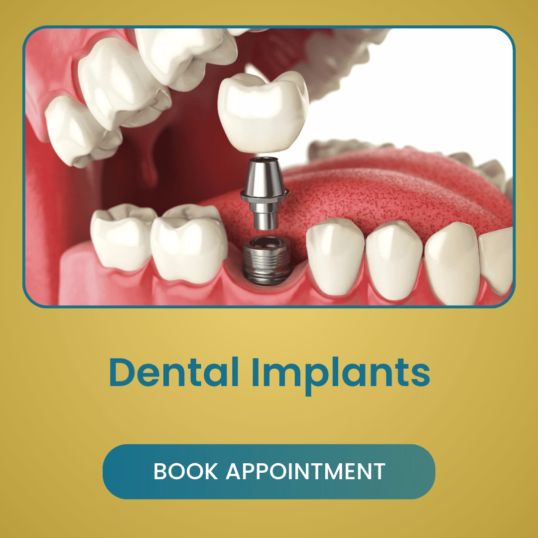 Dental Implants