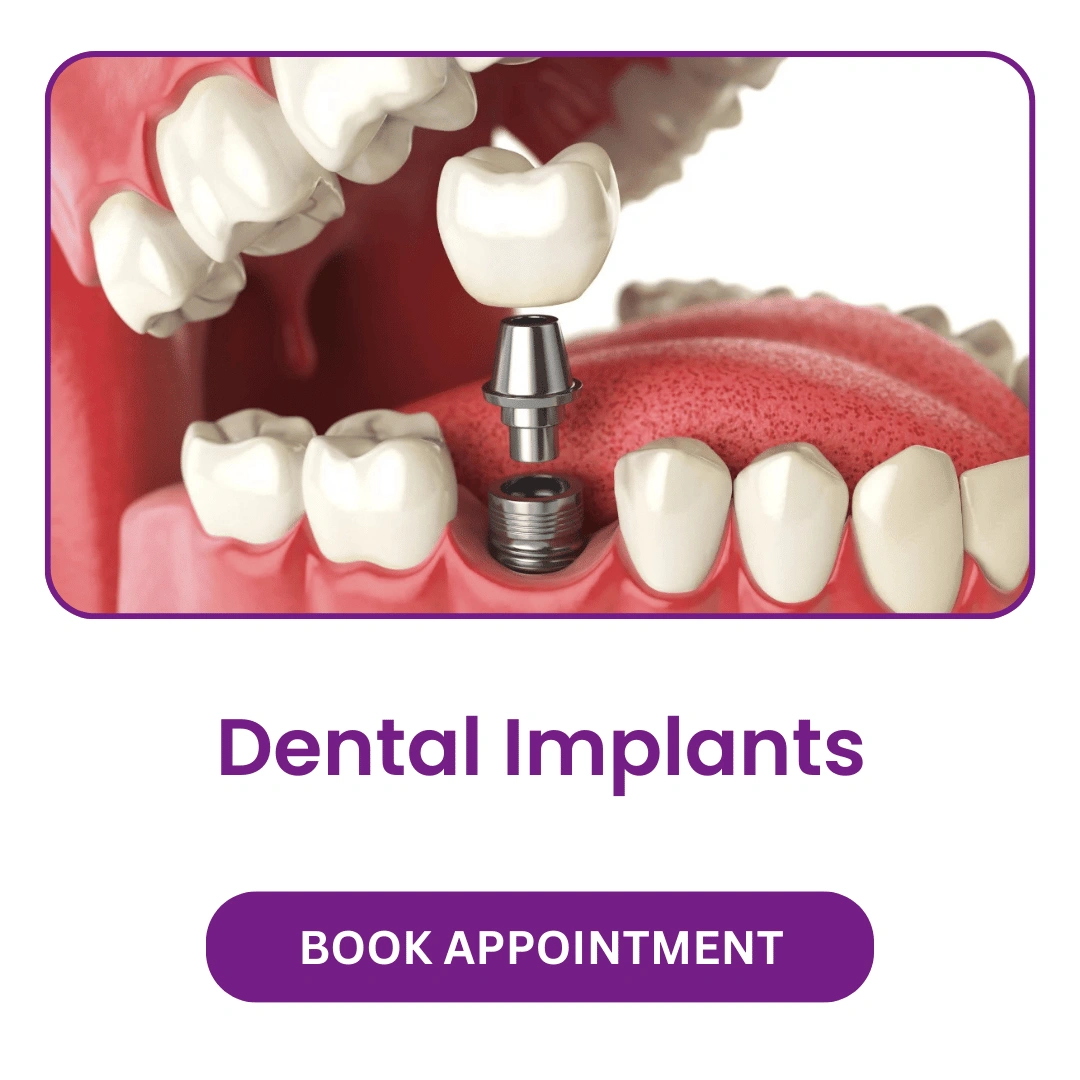 Dental-Implants.webp