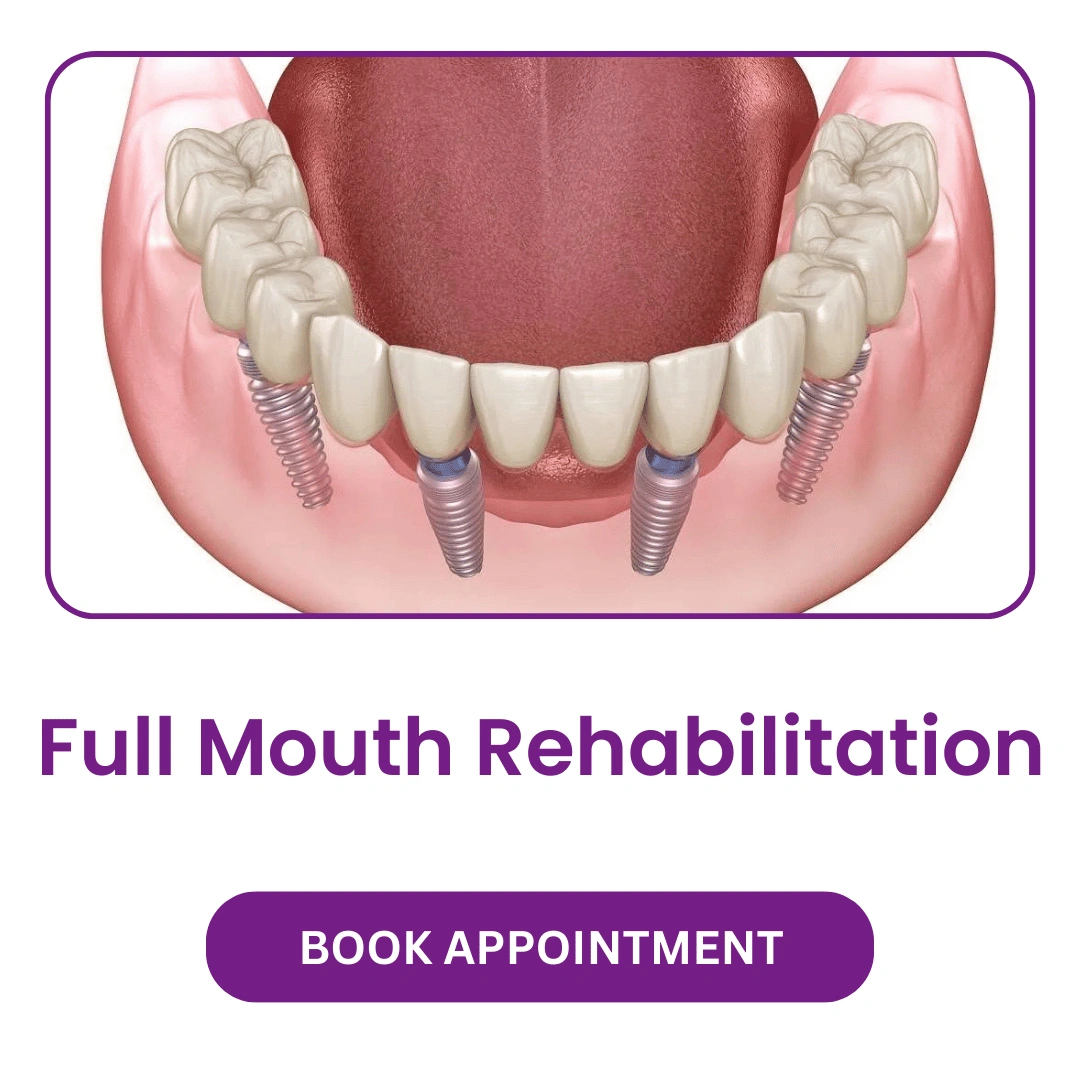 Full-Mouth-Rehabilitation.webp