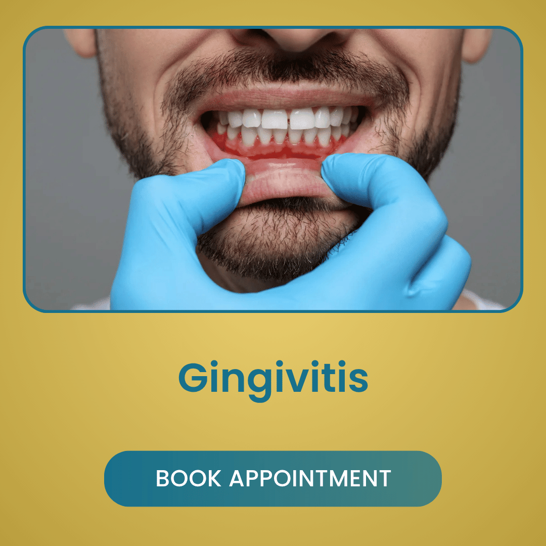 Gingivitis