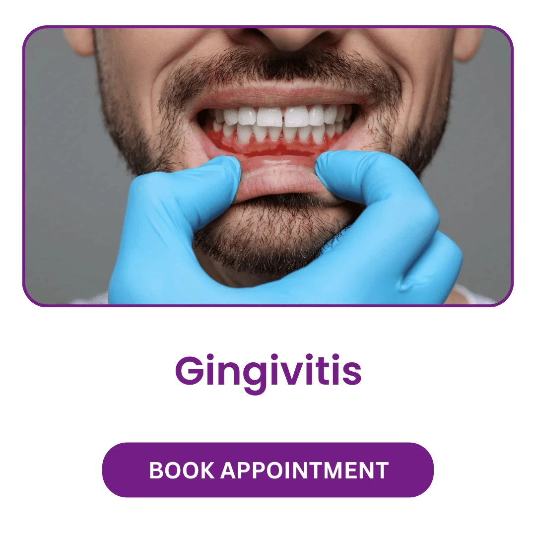 Gingivitis.webp