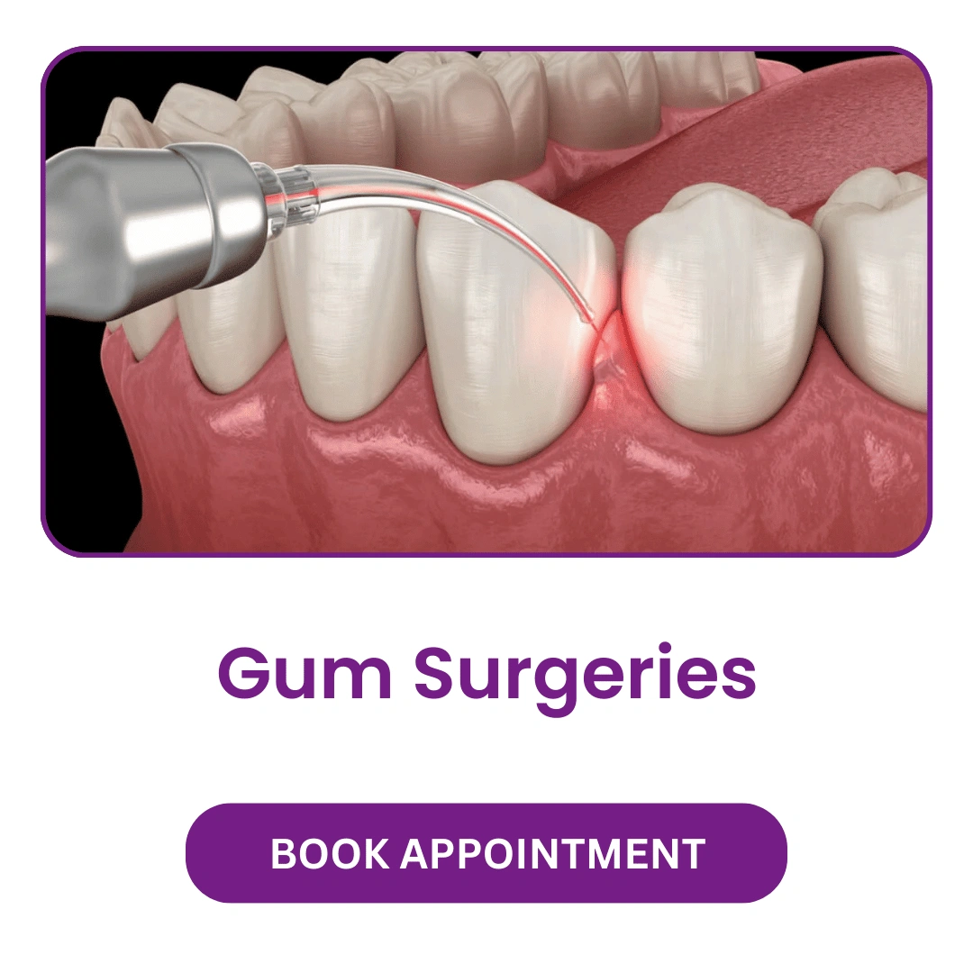 Gum-Surgeries.webp
