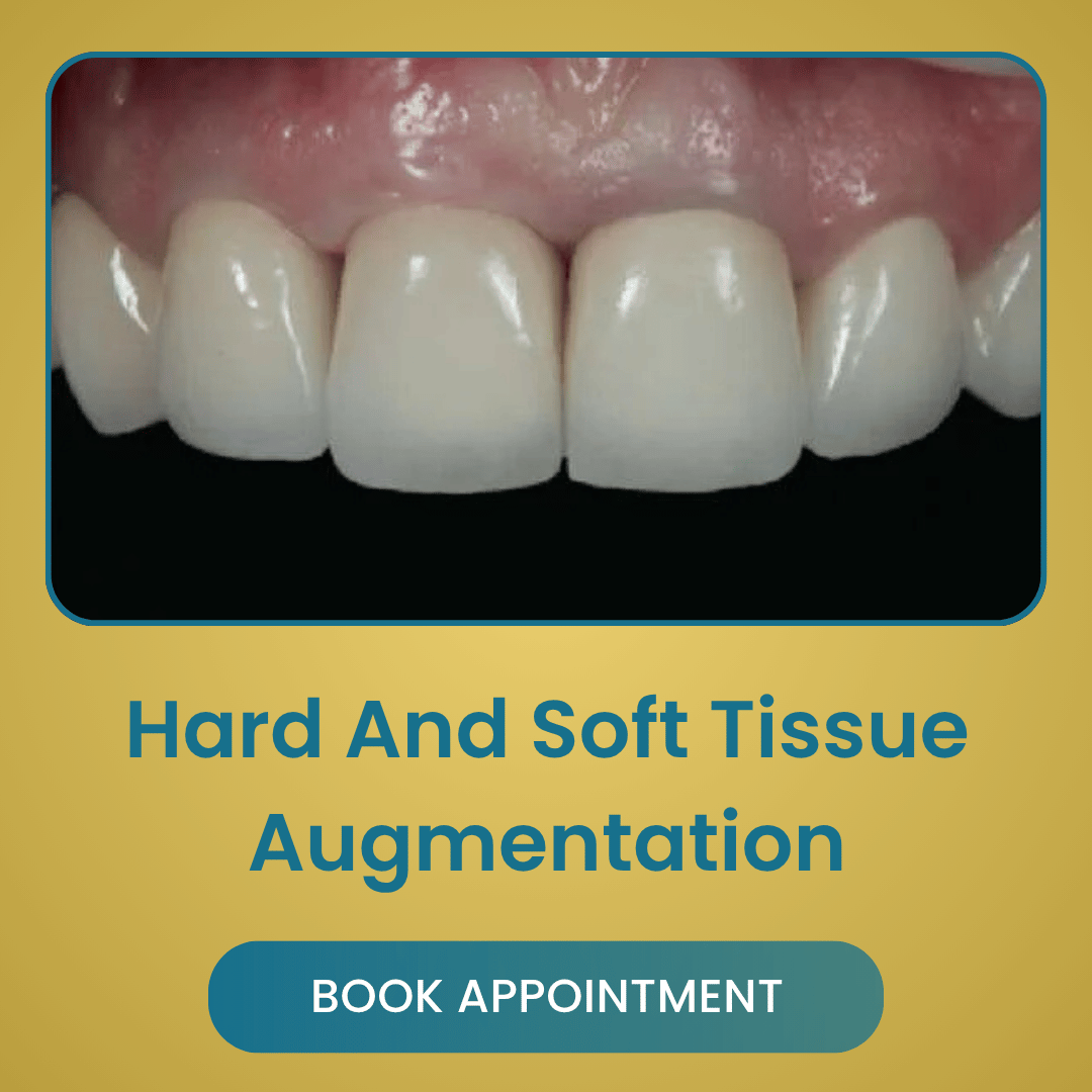 Hard And Soft Tissue Augmentation
