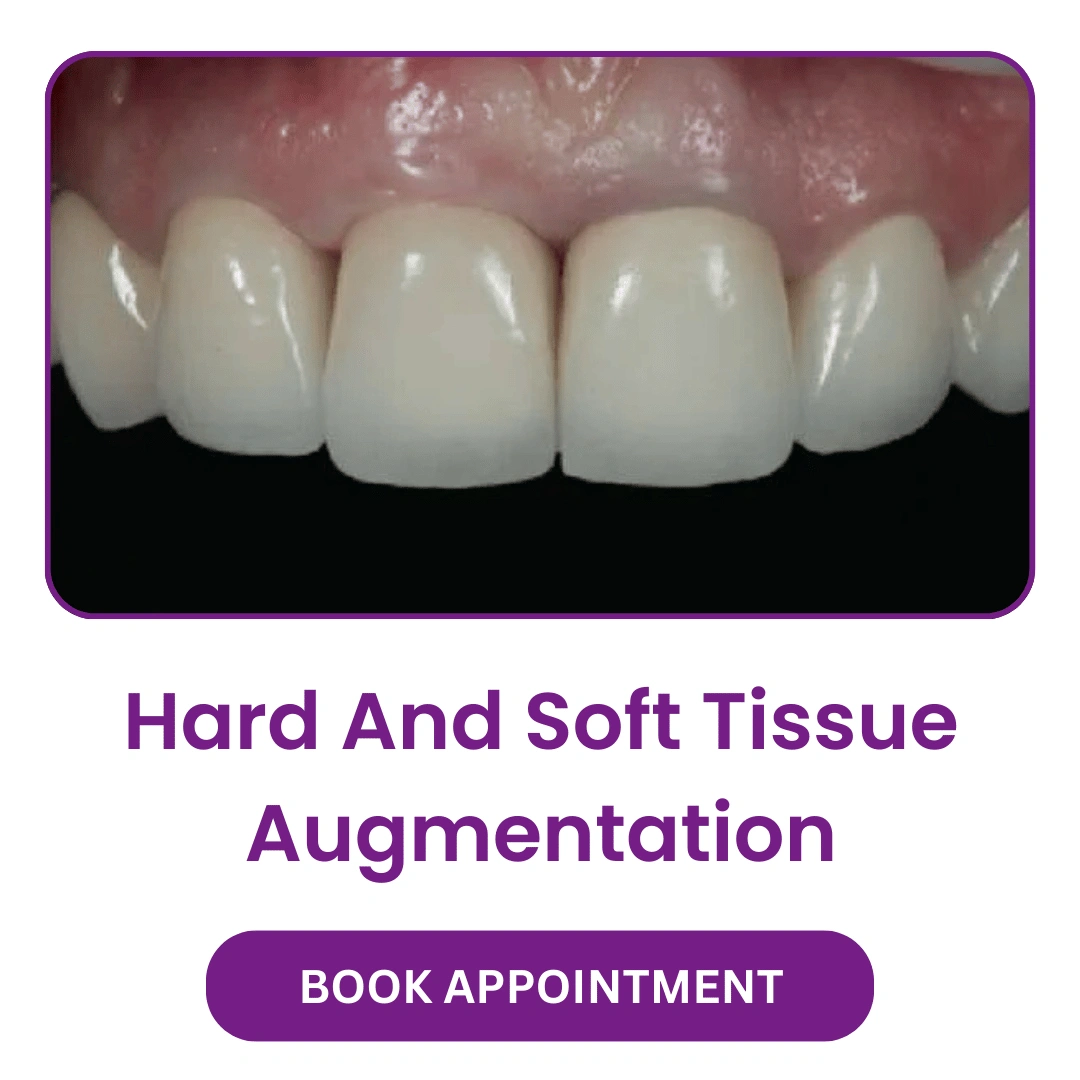 Hard-And-Soft-Tissue-Augmentation.webp
