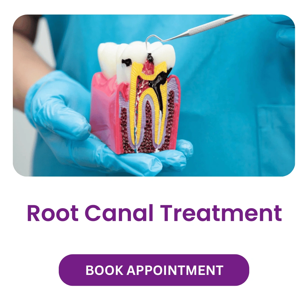 Root-Canal-Treatment.webp