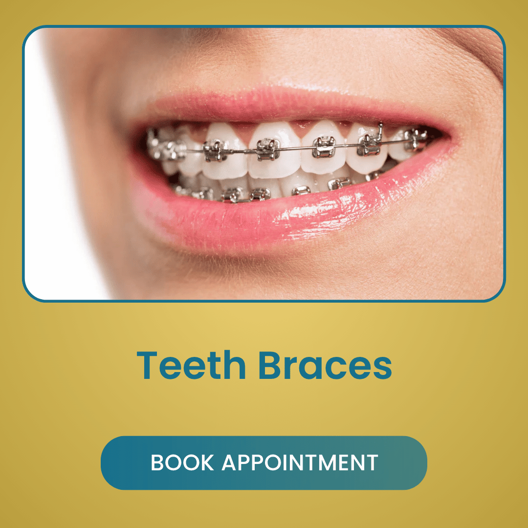 Teeth Braces