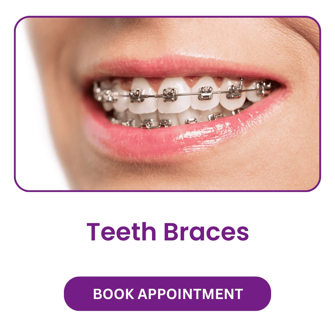 Teeth-Braces.webp