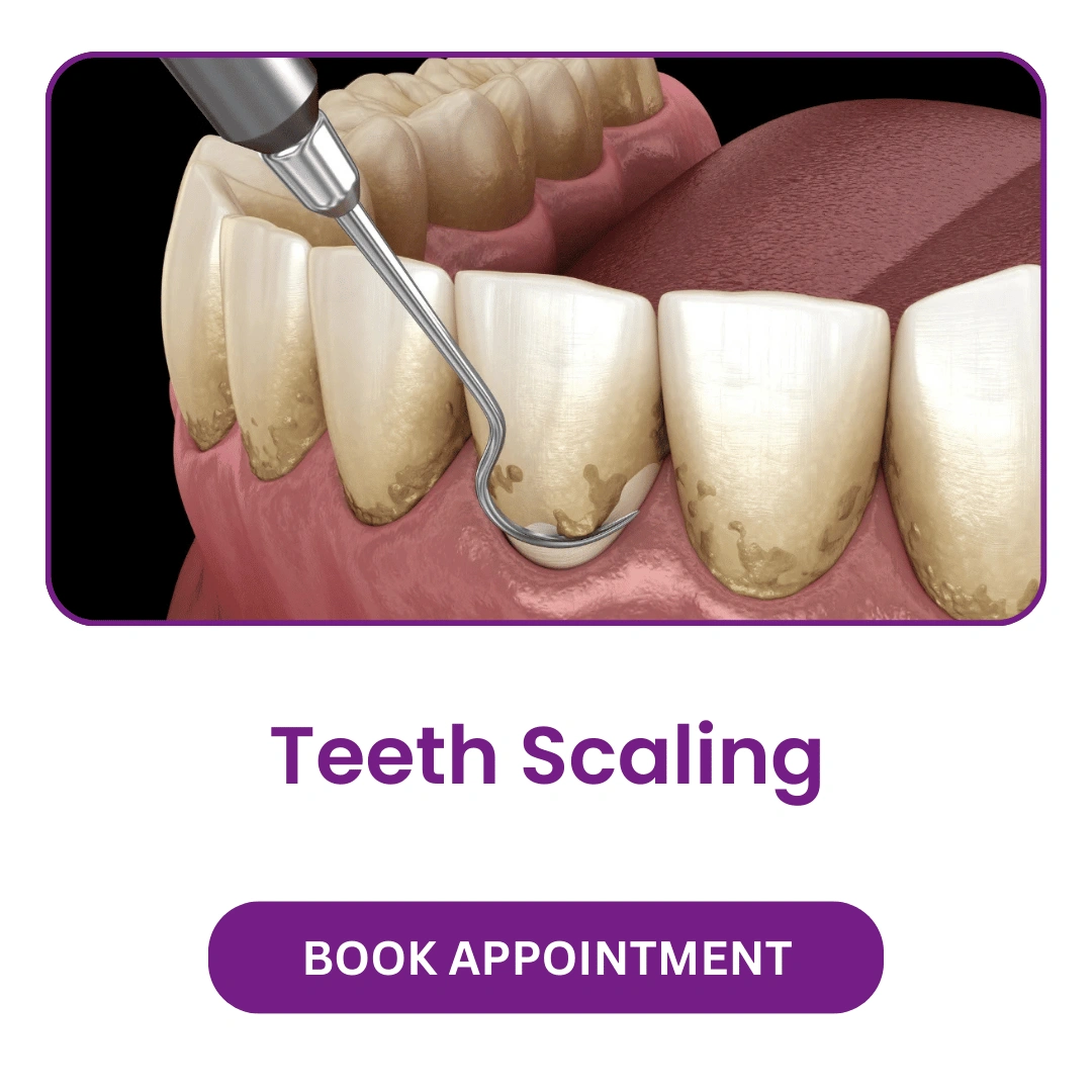 Teeth-Scaling.webp