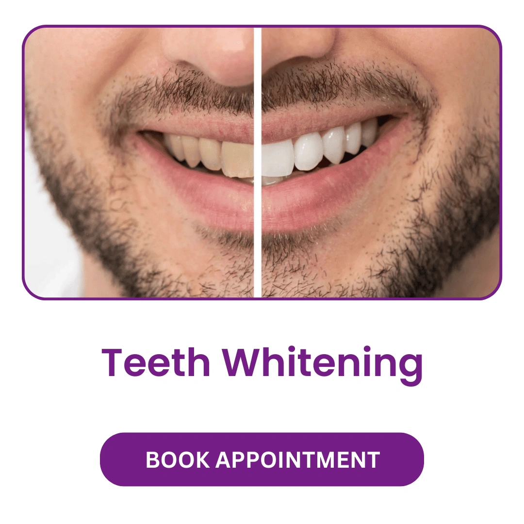 Teeth-Whitening.webp