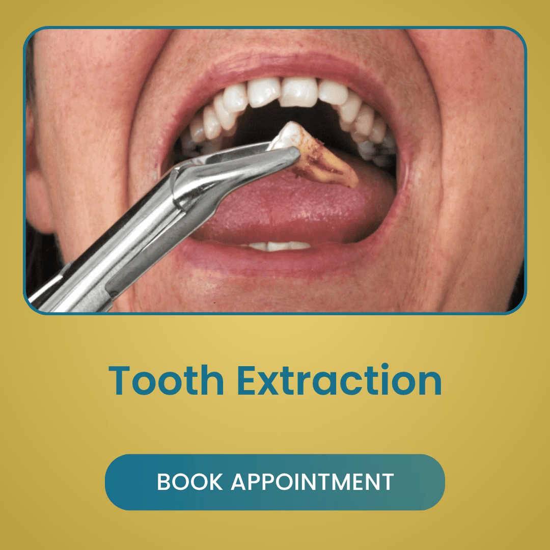 Tooth Extraction