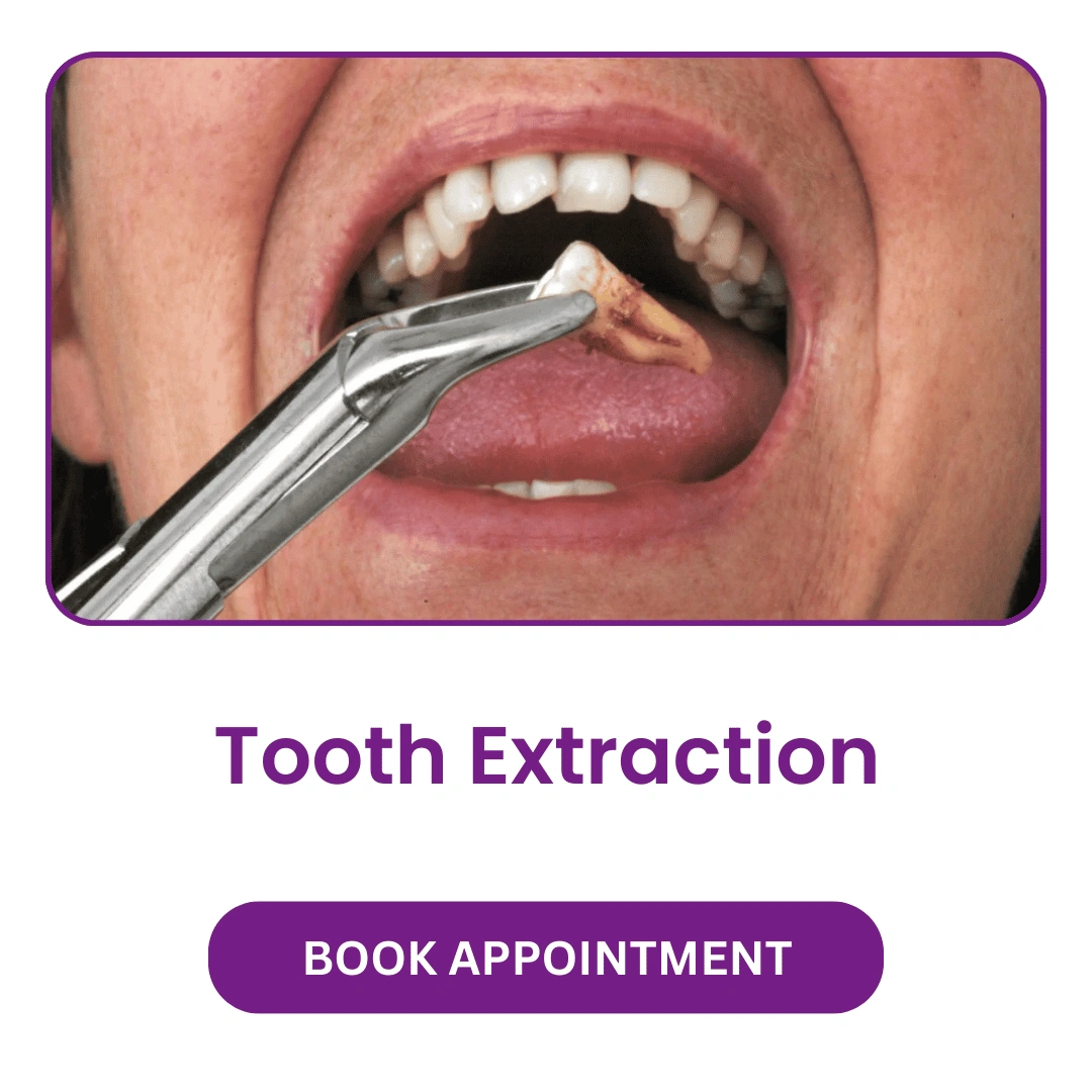 Tooth-Extraction.webp